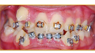 BraCKETS antes y DESpués MiRa CoMo FunCiOnAn😁 [upl. by Hecker]