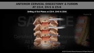 Anterior Cervical Discectomy amp Fusion at C34 C45 amp C56 [upl. by Tia]