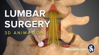 Lumbar Surgery  Laminectomy  3D Medical Animation [upl. by Bobseine]