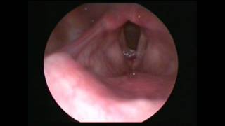 Vocal cord polyp Satyam Ent Care Centre Gwalior Dr Ravindra Bansal [upl. by Deuno]