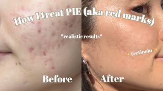 How I treat the PIE aka red marks on my cheeks  Tretinoin tips  Products I used [upl. by Llerahs]