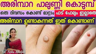 അരിമ്പാറ  പാലുണ്ണി 1 ദിവസം കൊണ്ട് മാറ്റം How To Get Rid Of Warts NEW Dr Tisha Adolph Malayalam [upl. by Paulson731]