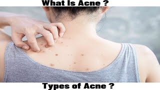 What Is Acne Types Of Acne [upl. by Mohkos]