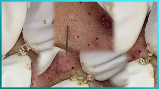 Big Cystic Acne Blackheads Extraction Blackheads amp Milia Whiteheads Removal Pimple Popping [upl. by Grimbald286]