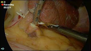 liver cyst deroofing  cholecystectomy [upl. by Aikahc827]