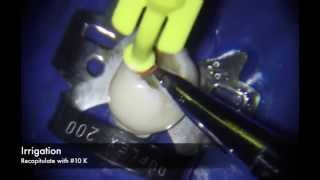 Manual Technique for Curved Root Canal Preparation [upl. by Marla]