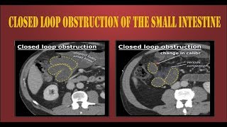 Closed loop obstruction of the small intestine [upl. by Ettena]