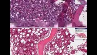 Histopathology Bone marrow  adenocarcinoma metastatic [upl. by Ianteen894]