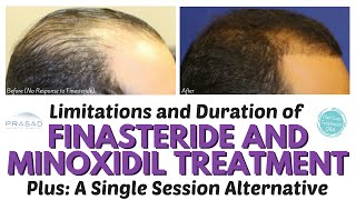 The Lifelong Duration of Finasteride and Minoxidil Hair Loss Treatment and a OneTime Alternative [upl. by Ytsim]