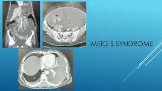 MEIGS SYNDROME [upl. by Ocire]