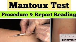 Mantoux Test in Hindi  Tuberculin Skin Test  mantoux test results reading [upl. by Austin193]