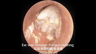 Ear wax removalFungus cleaning 耳垢清除和真菌清理20230910 [upl. by Eniluqcaj412]