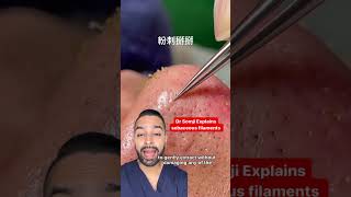 sebaceous filaments nose extraction  Dr MediSpa [upl. by Mylo]