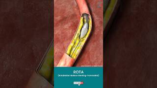 What is a Rotablation Balloon Stenting ↪ 3D Medical Animation Shorts ROTA Angioplasty [upl. by Salvador]