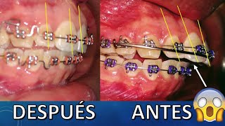 ¿Como mejorar dientes proinclinados sin la extracción de dientes premolares en algunos casos😎✌ [upl. by Philbrook150]