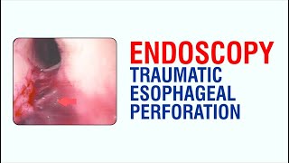 Endoscopy Traumatic Esophageal Perforation  Best Gastroenterologist Doctor in Patna [upl. by Odlanyar415]