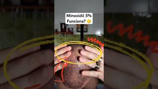 MINOXIDIL HAIRLOSS  CALVIZIE E ALOPECIA minoxidil calvizie alopecia hairloss cadutacapelli [upl. by Shaylynn]