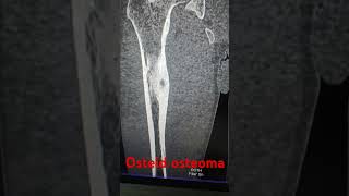 Osteid osteoma ctscan radiology bones anatomy case interesting doctor [upl. by Htinnek]