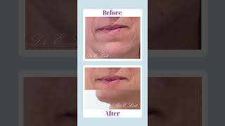 Before amp After filler Injection [upl. by Gaven]