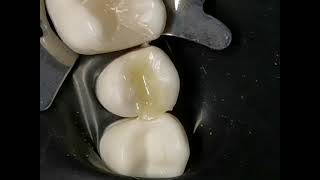 Composite restoration class 1 upper premolar [upl. by Yeldua]