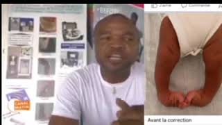 Correction pied Bot sans CHIRURGIE en 2 mois Dr Ben Nkama [upl. by Kelula]