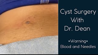 Cyst removal with Dr Dean [upl. by Mutua]