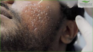 TCA Cross FULL TREATMENT for Acne Scars  Los Angeles [upl. by Gnuhp243]