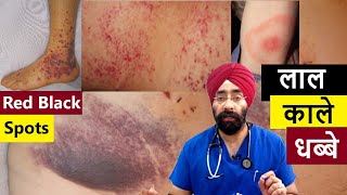 Red Black Spots on the Skin  चमड़ी पे लाल काले धब्बे  DrEducation [upl. by Hwu]