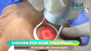 How to remove Chicken Pox Scars from Face and Body by Laser Treatment at Skinaa Jaipur [upl. by Yrtnahc]