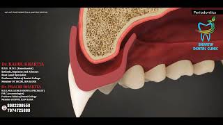 DENTURE  PERIODONTICS [upl. by Gottfried]