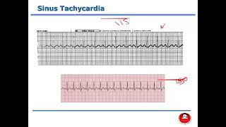 Adult Health Nursing I 20222023  Lecture 15 ECG  Part 2 [upl. by Kawai]