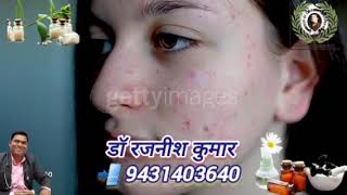 Eczema Vitiligo Leucoderma Ringworm SkinDiseaseElectrohomeopathyTreatment [upl. by Ahsenom]