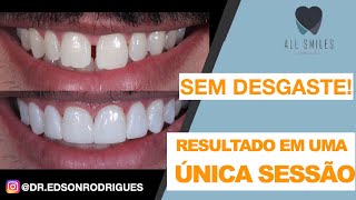 TRANSFORME SEU SORRISO Lentes de Resina explicadas passo a passo [upl. by Ahsineb]