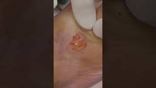 Popping a HUGE foot CYST🤣🤯pimplepopping [upl. by Toscano330]