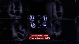 dobutamine stress echocardiogram DSE [upl. by Lavinia]