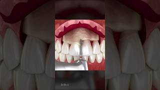 Frontal Crown Lengthening Dental Procedure [upl. by Juliette]