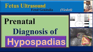 Fetus Ultrasound Prenatal Diagnosis of Hypospadias [upl. by Barmen466]