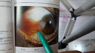 PTERYGIUM verry IMPORTANT conjuctival condition explanation with scenario [upl. by Seppala]