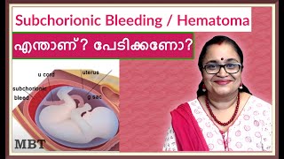 Subchorionic HematomaBleeding In Pregnancy What Is It Should You Be Afraidഎന്താണ്പേടിക്കണോMBT [upl. by Anyd]