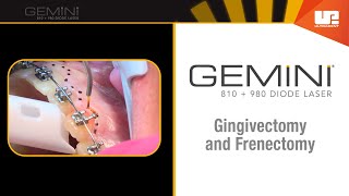 Gingivectomy and Frenectomy for Orthodontics  How to Use the Gemini™ Laser [upl. by Alysia]