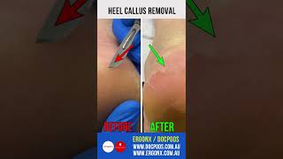 Heel Callus Removal [upl. by Odinevneib]