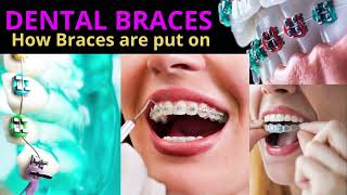 What are Dental Braces kya hote hai Types of Braces costInvisalign Invisible Aligners  Lingual [upl. by Swords]