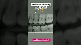 Horizontal Bitewing Radiograph  Dental radiograph [upl. by Laemsi]