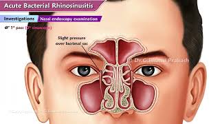 Acute Bacterial Rhinosinusitis ABRS  ENT Lectures [upl. by Adilem]