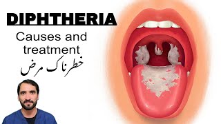 Diphtheria  Symptoms Causes and treatment [upl. by Winnifred]