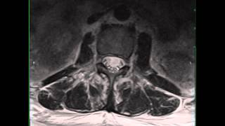 Infectious Arachnoiditis [upl. by Nirol]