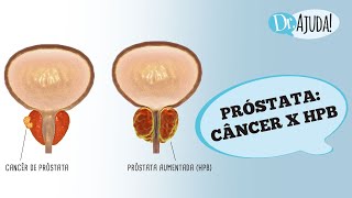 5 PRINCIPAIS DIFERENÇAS CÂNCER DE PRÓSTATA E CRESCIMENTO BENIGNO DA PRÓSTATA [upl. by Terr]