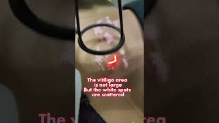 New Laser Treatment for Vitiligo 2023 [upl. by Anitirhc156]