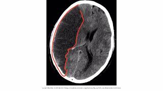 Ischemic Stroke  Neurology  video   part 1 educational full video English [upl. by Ham]