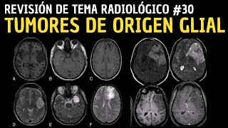 Revisión de Tema Radiológico 30 Tumores de origen glial [upl. by Atews]